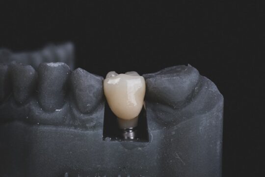Implantes dentales inmediatos todo lo que debes saber