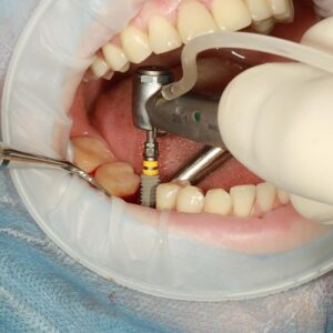 cuidados después de un implante dental